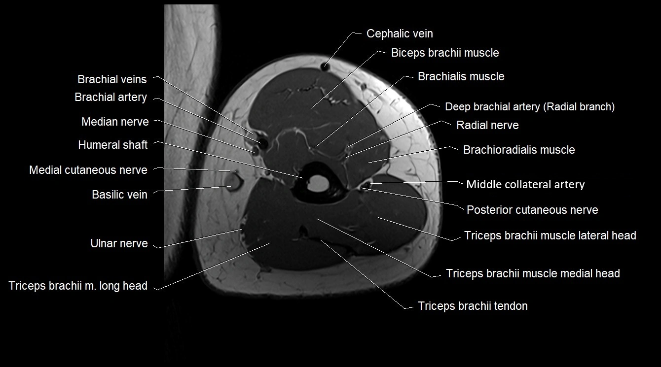 Upper arm( humerus) cross section anatomy MRI 3T axial image 45.webp